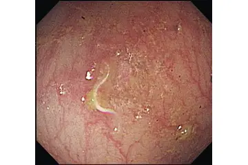 Kıl Kurdu Belirtileri Nelerdir?